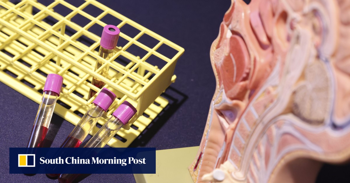 Blood test developed by Hong Kong researchers can detect nasopharyngeal
