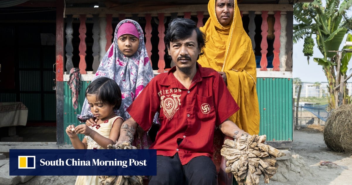 ‘The pain is unbearable’: viral ‘tree man’ with extremely rare disease ...