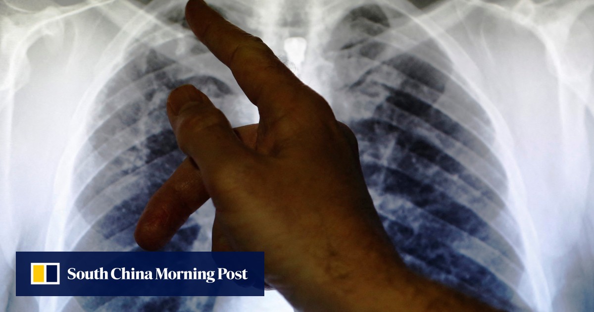 Japan to require visitors from China test negative for tuberculosis