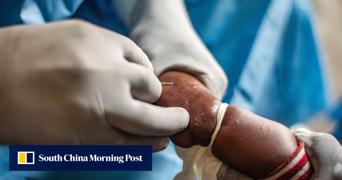 Pakistan reports first case of deadly mpox virus