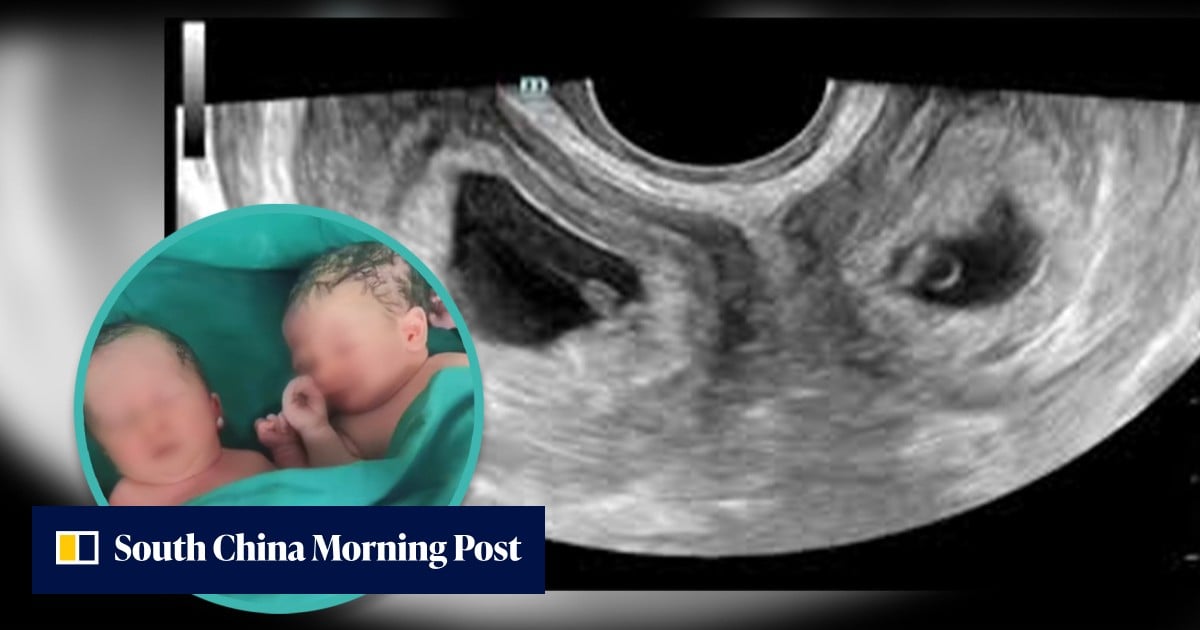 Two Uteruses One in a million: China woman with 2 uteruses gives birth to a child ...