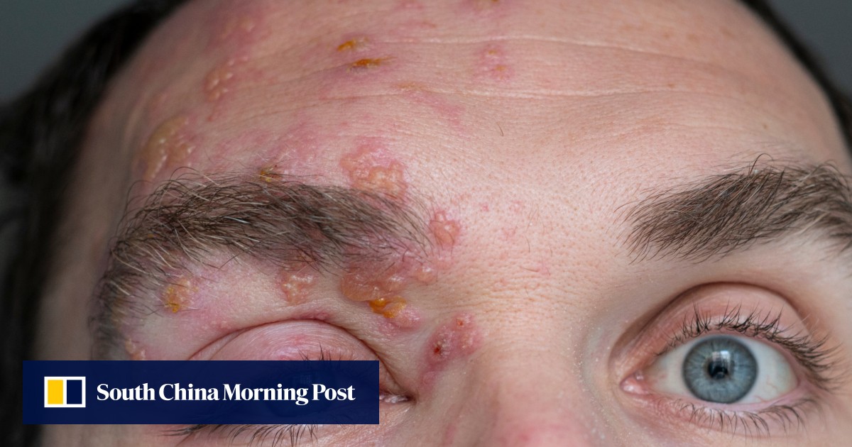 shingles on chin pictures
