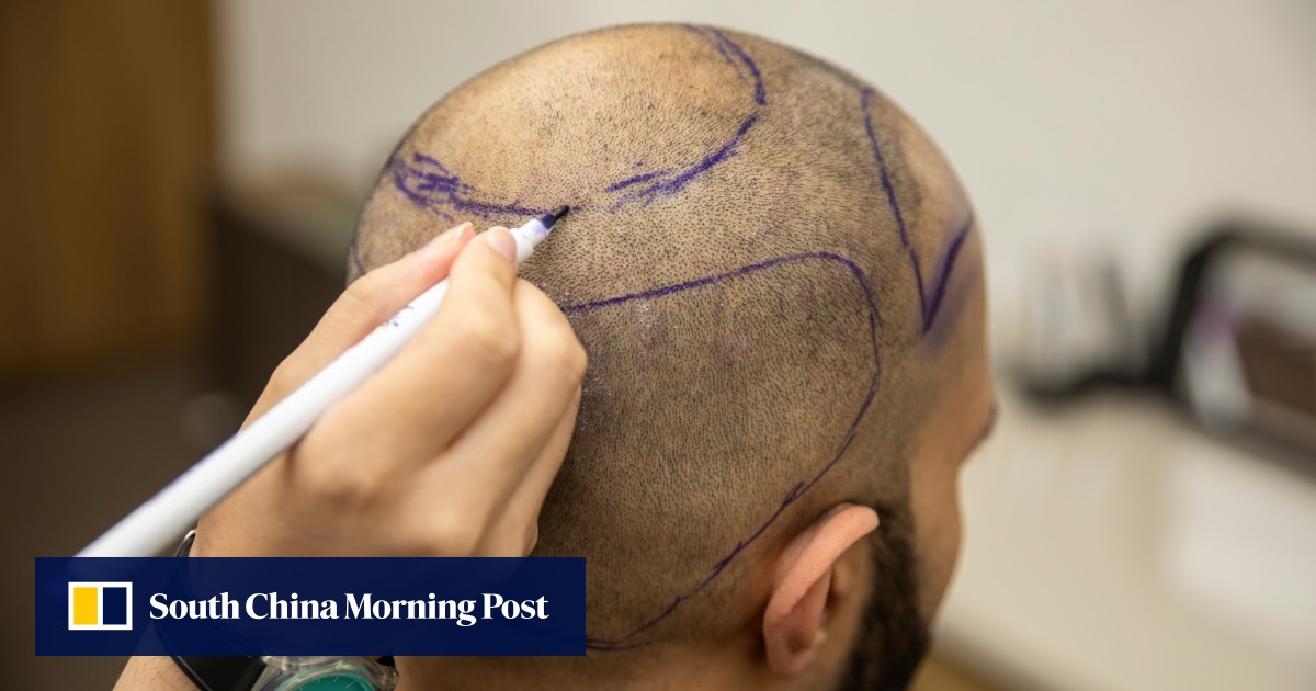 How this city became a hair transplant hub, and the headwinds it faces