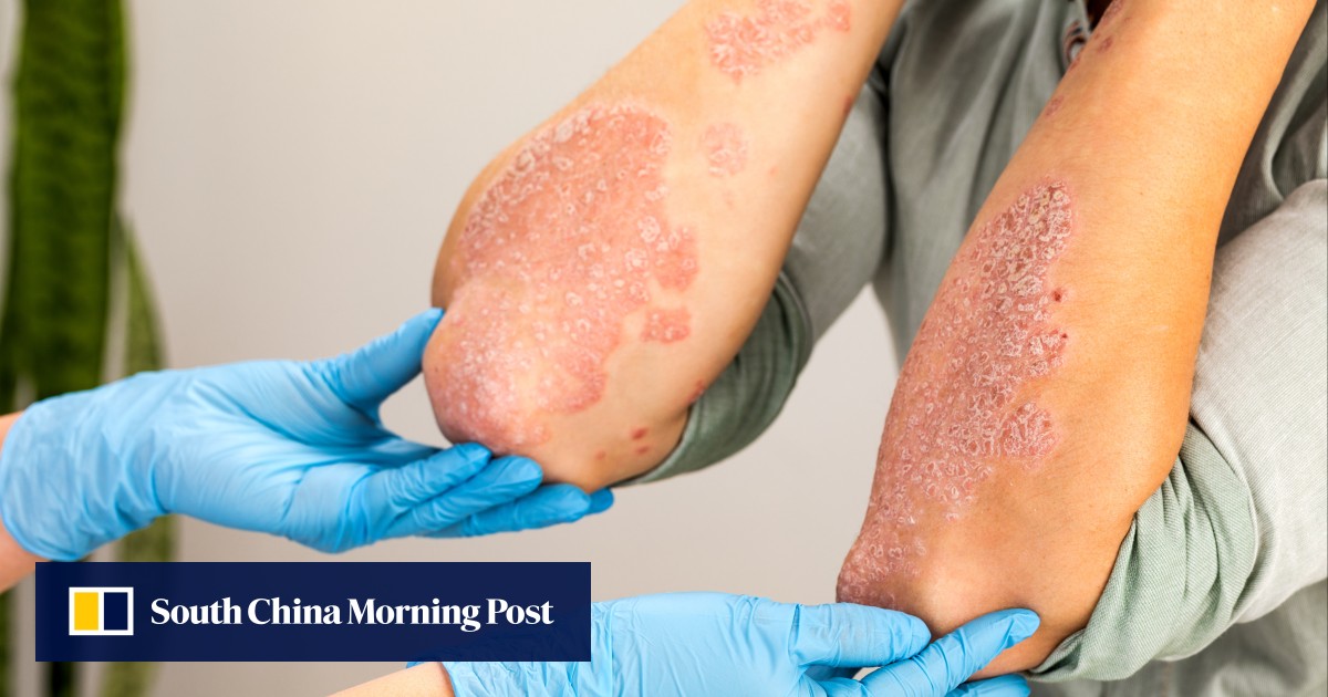 Why Fungal Diseases Could Be the Next Global Health Threat