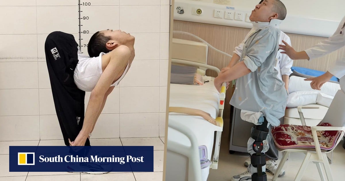 China ‘folded boy’ stands up straight for first time after gruelling surgeries