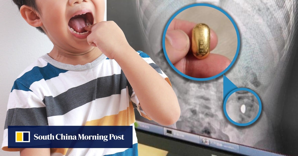 China boy swallows gold bean during ‘tongue exercise’, relieves himself in hospital