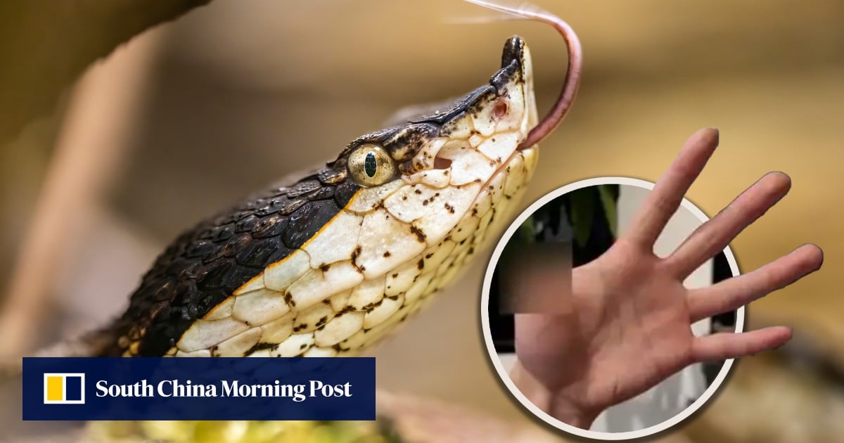 Chinese man hand-feeds pet snake, suffers serious bite, leads to thumb amputation