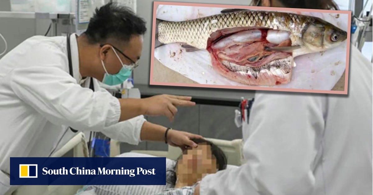 Chinese woman swallows raw fish gallbladder, hoping to relieve headache, ends up in ICU