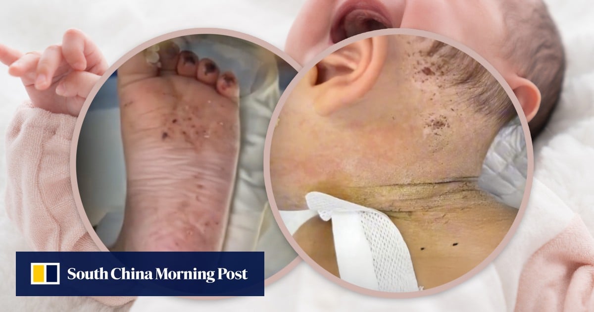 China baby hospitalised with 600 needle marks after mum stabs him for misbehaviour