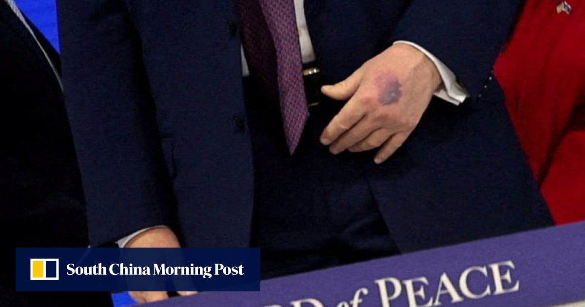 Trump blames table and aspirin after new bruise appears on his hand in Davos