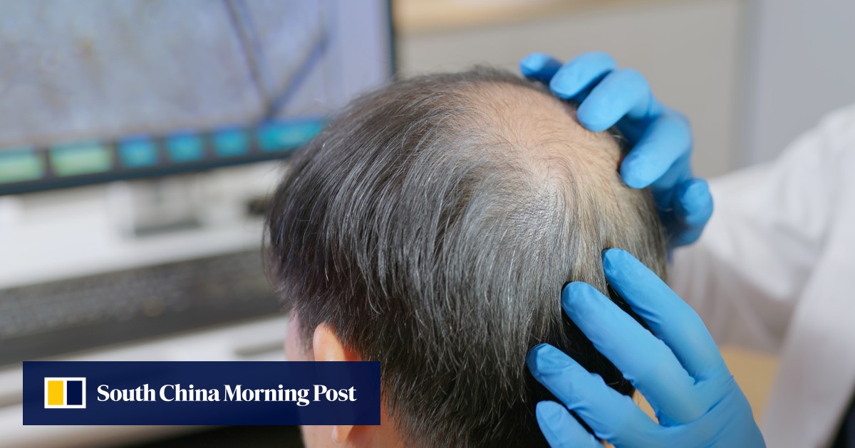 Hongkonger denied refund after HK$88,000 hair treatment causes scalp bleeding