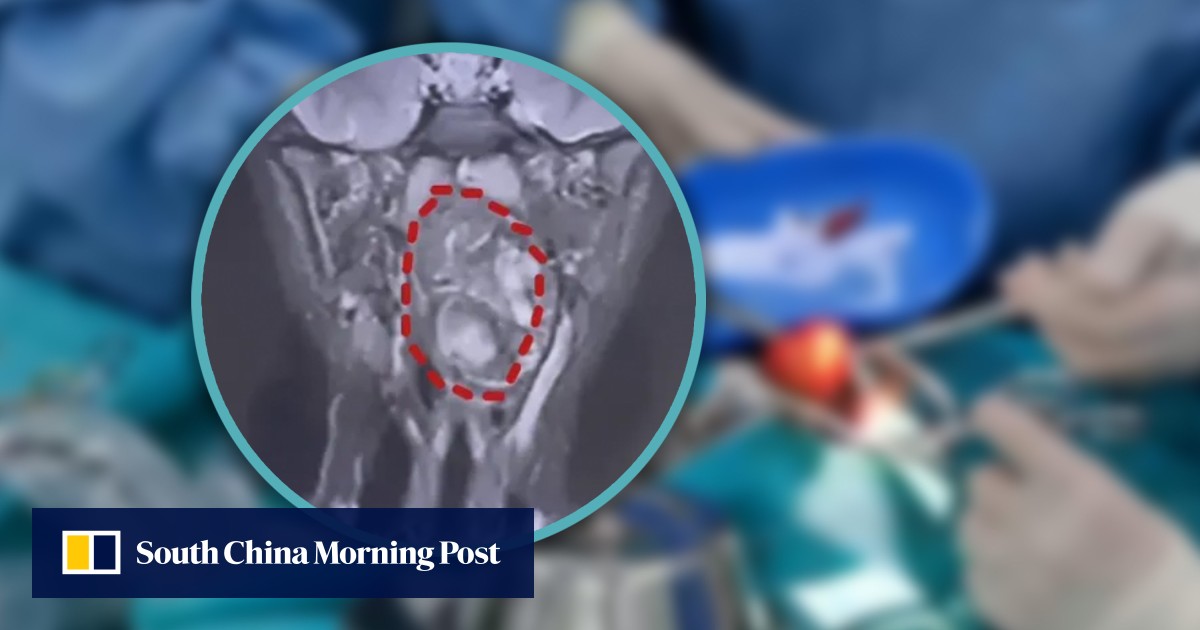 China boy, 6, discovers lump in throat that was thought to be ‘undeveloped twin’