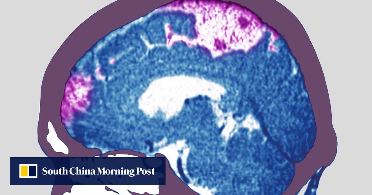 Why Hong Kong scientists think GLP-1 weight-loss drugs can help stroke patients
