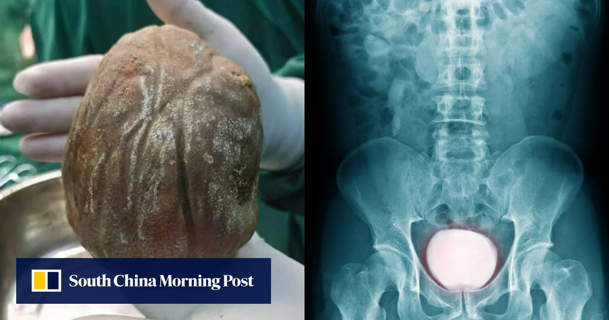 Chinese man suffers painful urination for 3 years discovers 1.3kg stone in his bladder