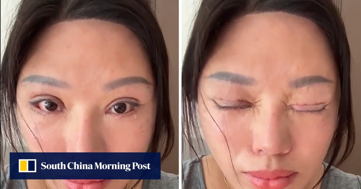 ‘Sleep with eyes open’: China woman’s bungled double eyelid surgery causes complications