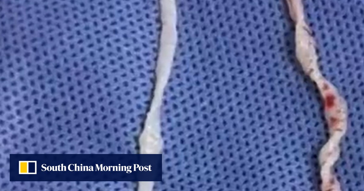 Chinese doctors remove pair of 10cm live worms from woman's arm after year-long pain