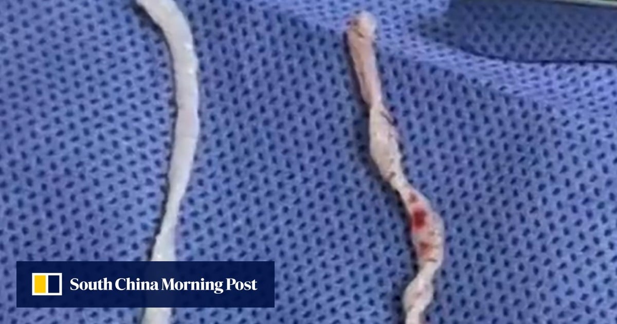 Chinese doctors remove pair of 10cm live worms from woman’s arm after year-long pain