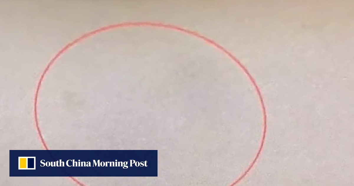 Chinese doctors remove pair of 10cm live worms from woman’s arm after year-long pain