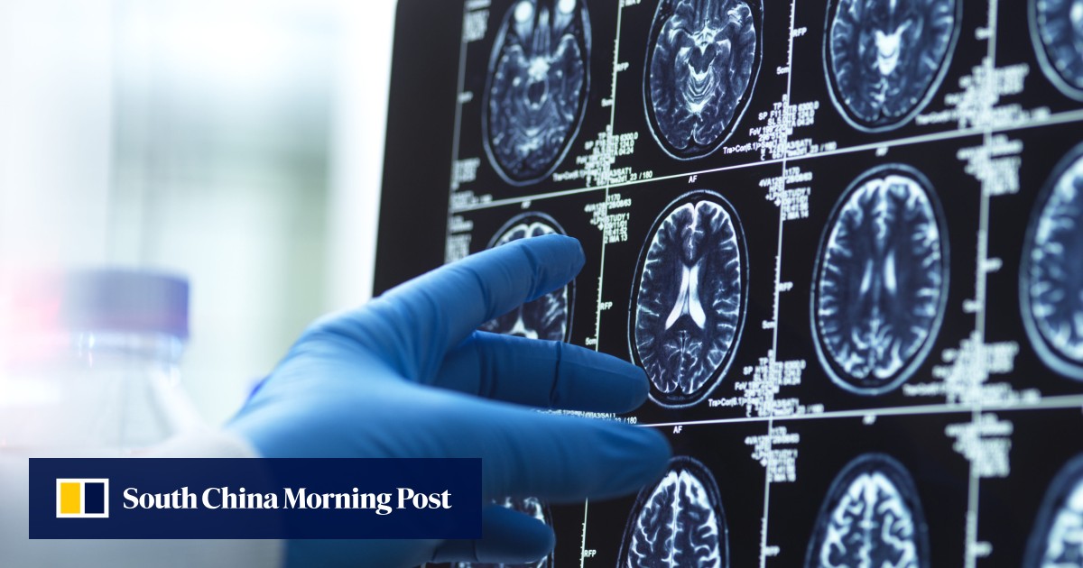 ‘A completely new person’: can surgery help Alzheimer’s patients regain basic skills?