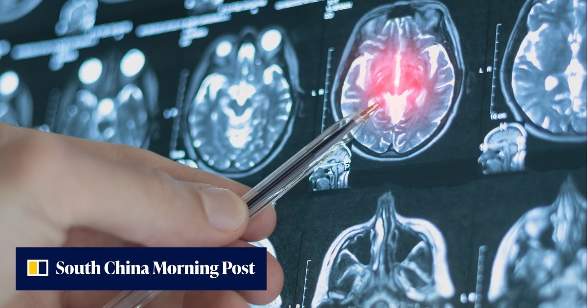 Chinese brain-reading AI model may help predict depression risk 4 years in advance