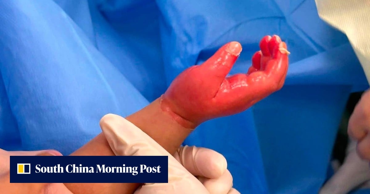 Domestic helper arrested after 1-year-old girl suffers burns in Hong Kong