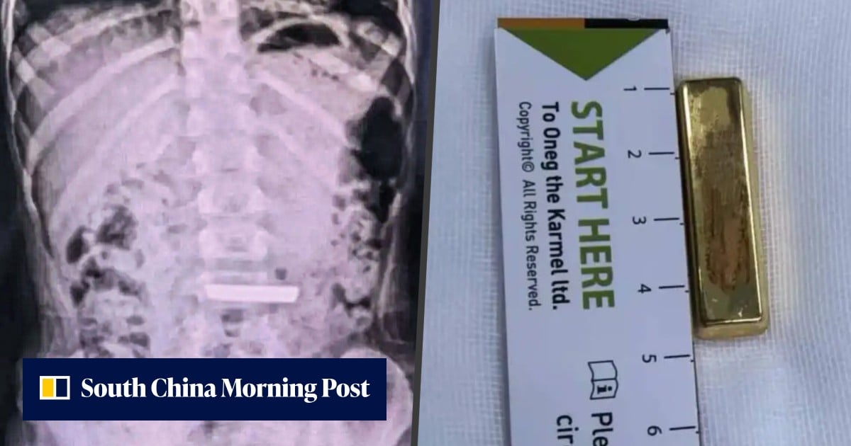 Real-life ‘gold-devouring beast’: Chinese girl, 5, hospitalised after swallowing gold bar