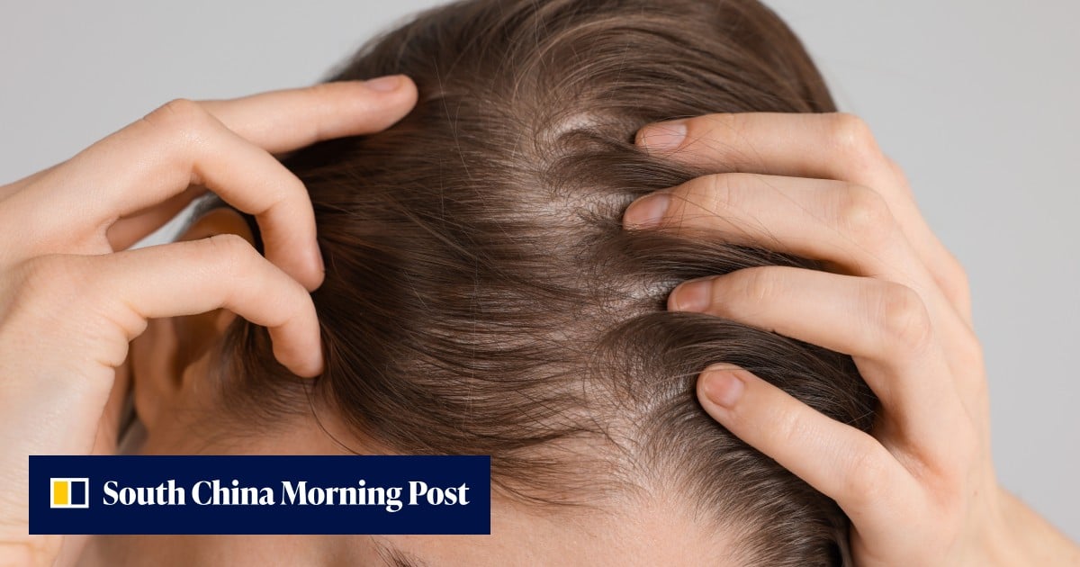 Arthritis drug restores 100% of hair on some patients with severe alopecia in global trial