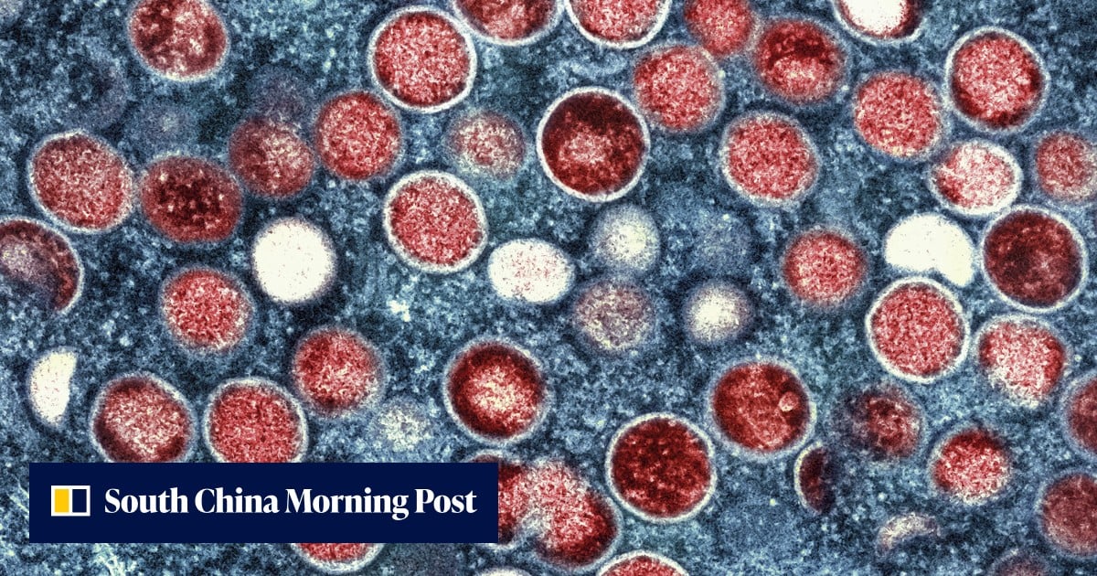 Hong Kong records 21 mpox cases since August, high-risk groups urged to get jabs
