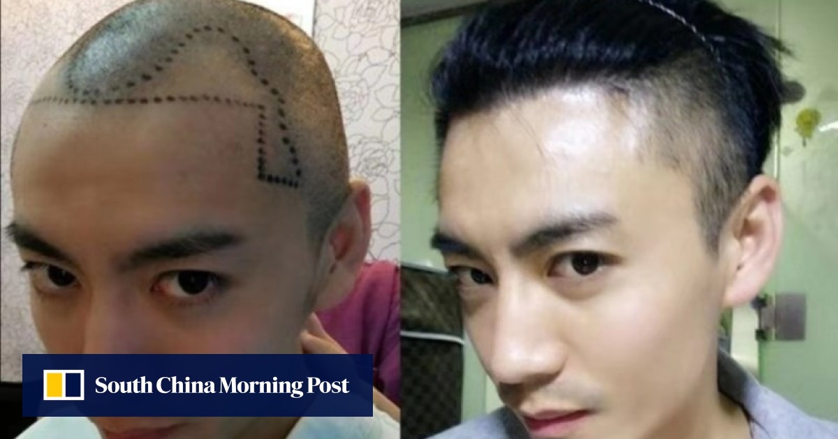 To baldly go: millennials fuel Asian rise in hair transplants - South China Morning Post