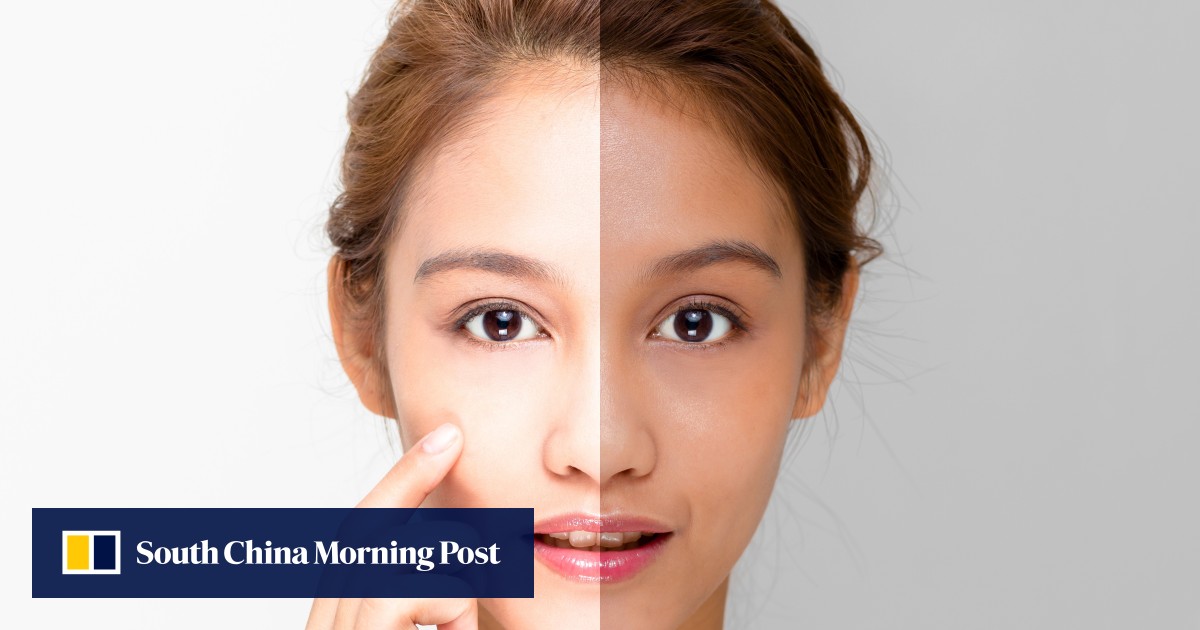 Skin-lightening cream puts woman in coma – here are the dangers to look