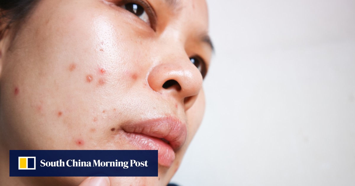 Adult acne and ‘maskne’ the myths, the facts, and the latest products