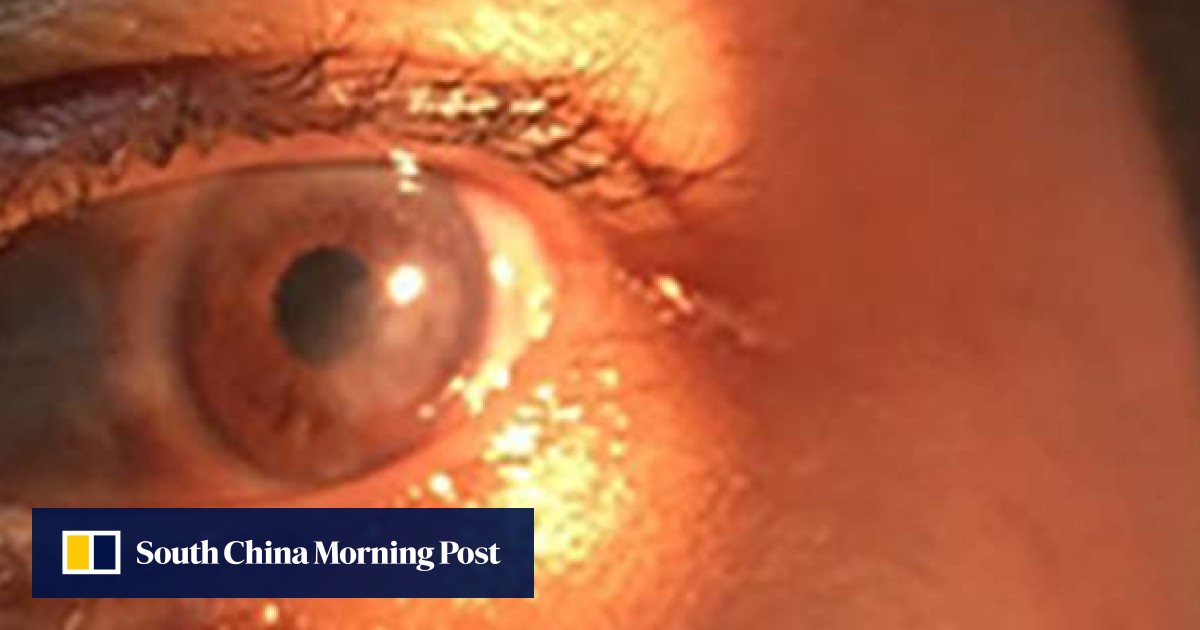 Chinese woman expected to regain eyesight after transplant using pig’s