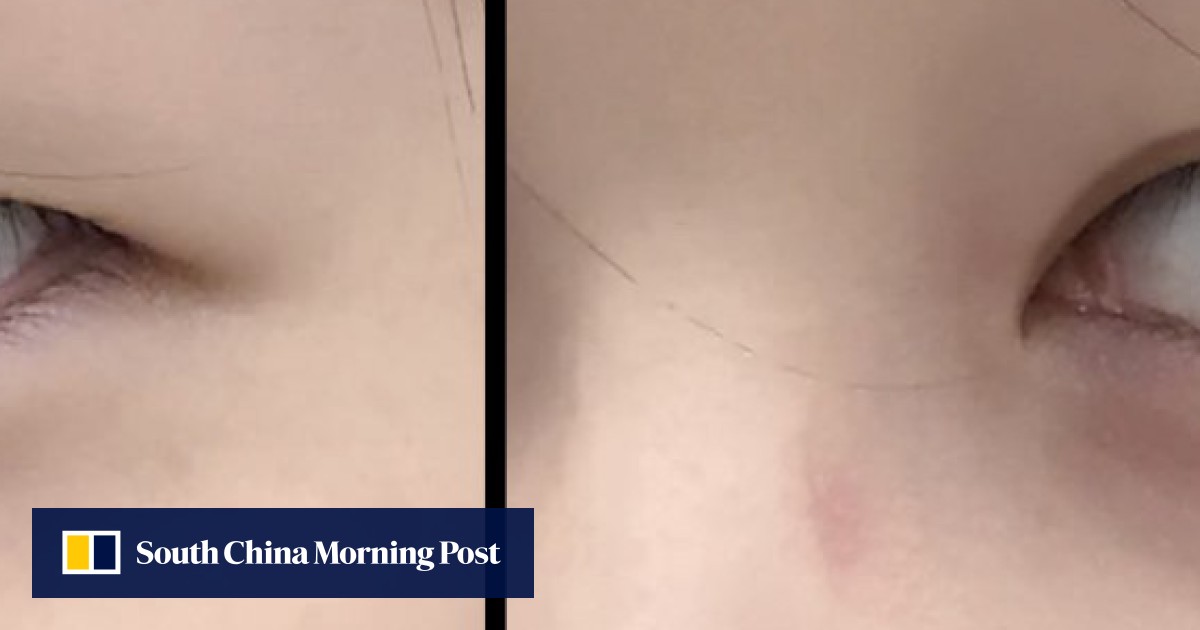 Double eyelid surgery hong kong on sale