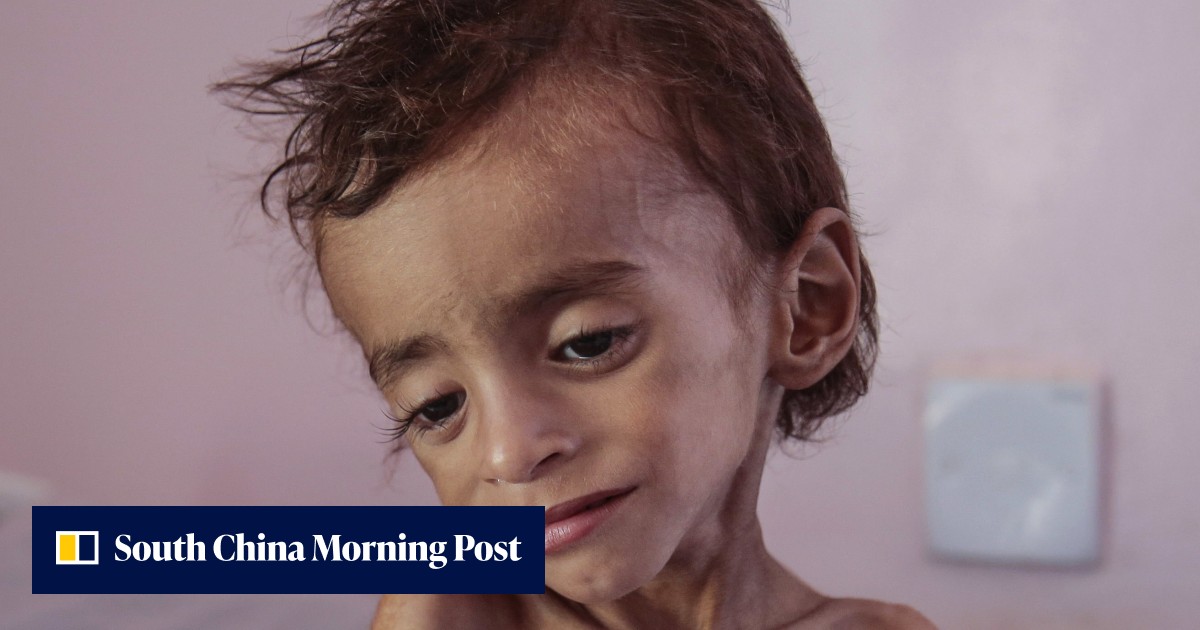 Up to 85,000 children have died of starvation or disease since Yemen ...
