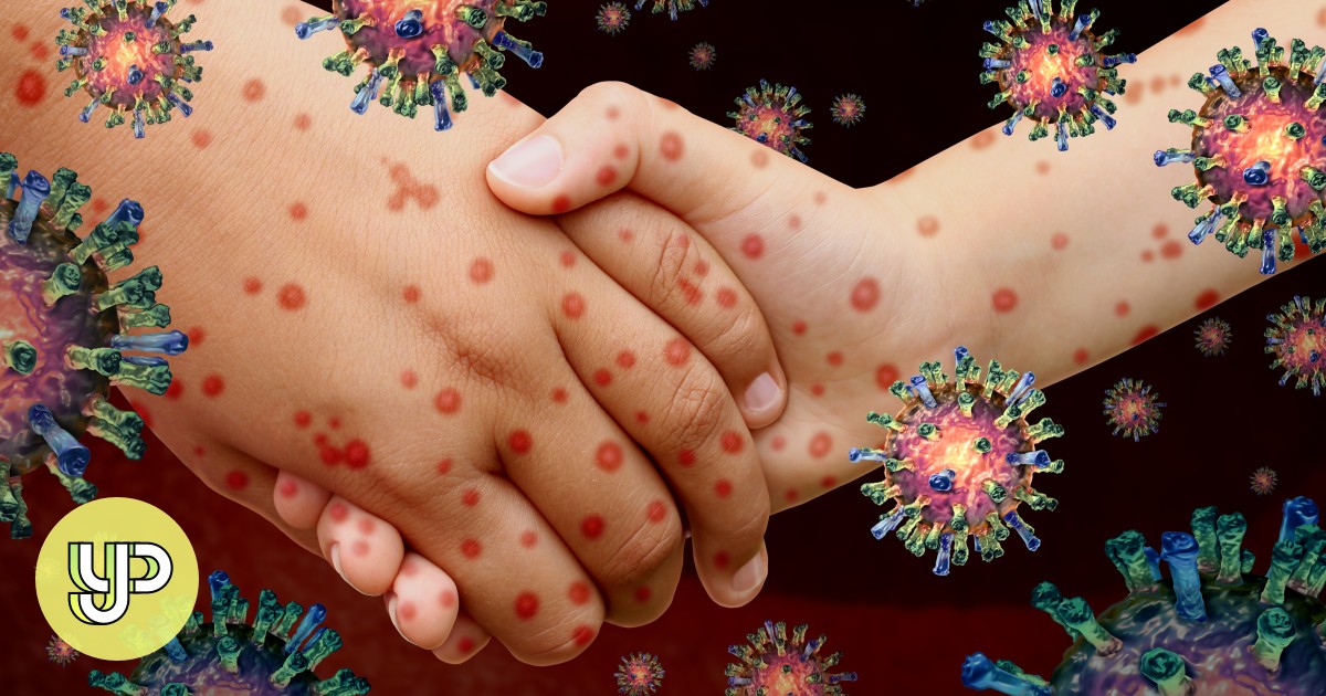 Hong Kong residents alerted about global measles resurgence; city logs 3 cases so far this year - YP - Vimarsana News