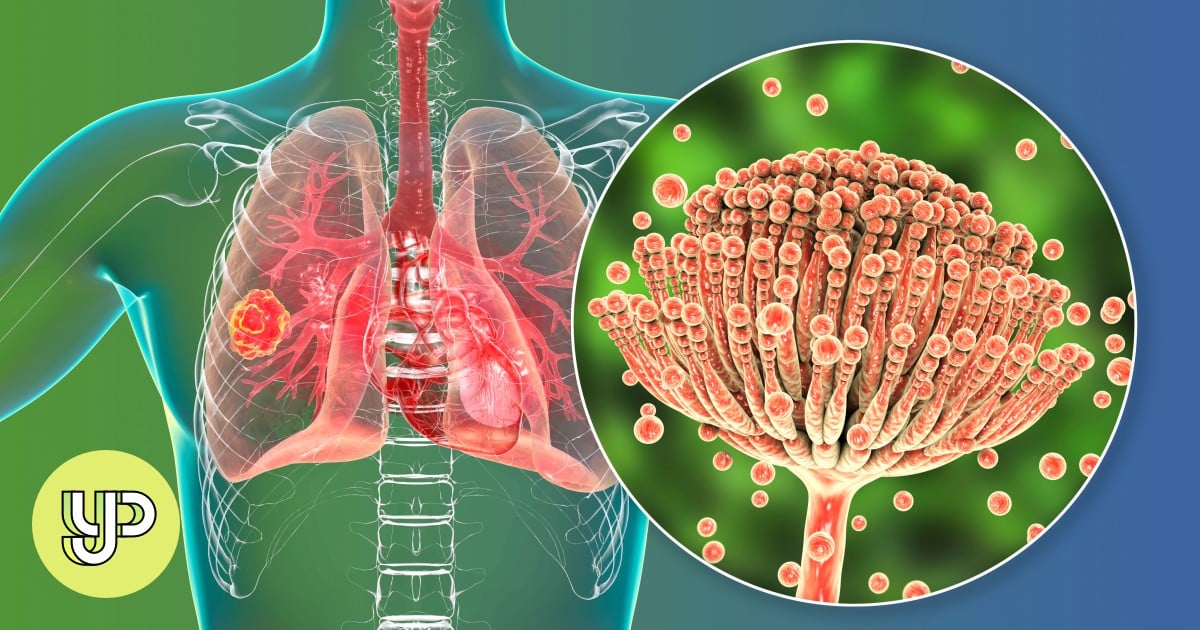 Spark Study Buddy (Challenger): Antifungal resistance emerges as a global health threat – Young Post Spark Study Buddy (Challenger): Antifungal resistance emerges as a global health threat – Young Post