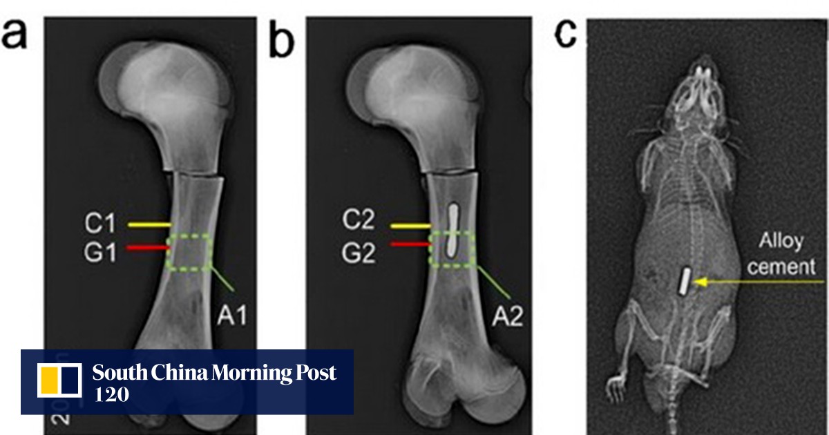 Chinese researchers test metal alloy to fix broken bones in minutes