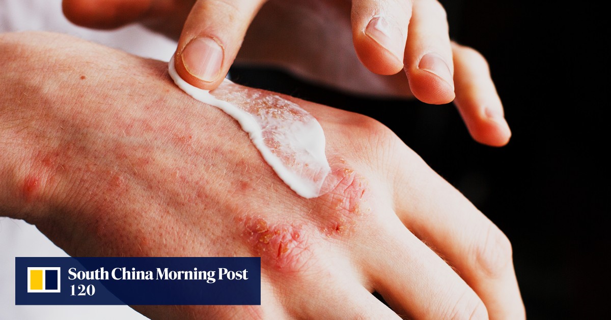 Singapore warns of arsenic-laced eczema cream sold in Malaysia with more than 430 times allowed limit