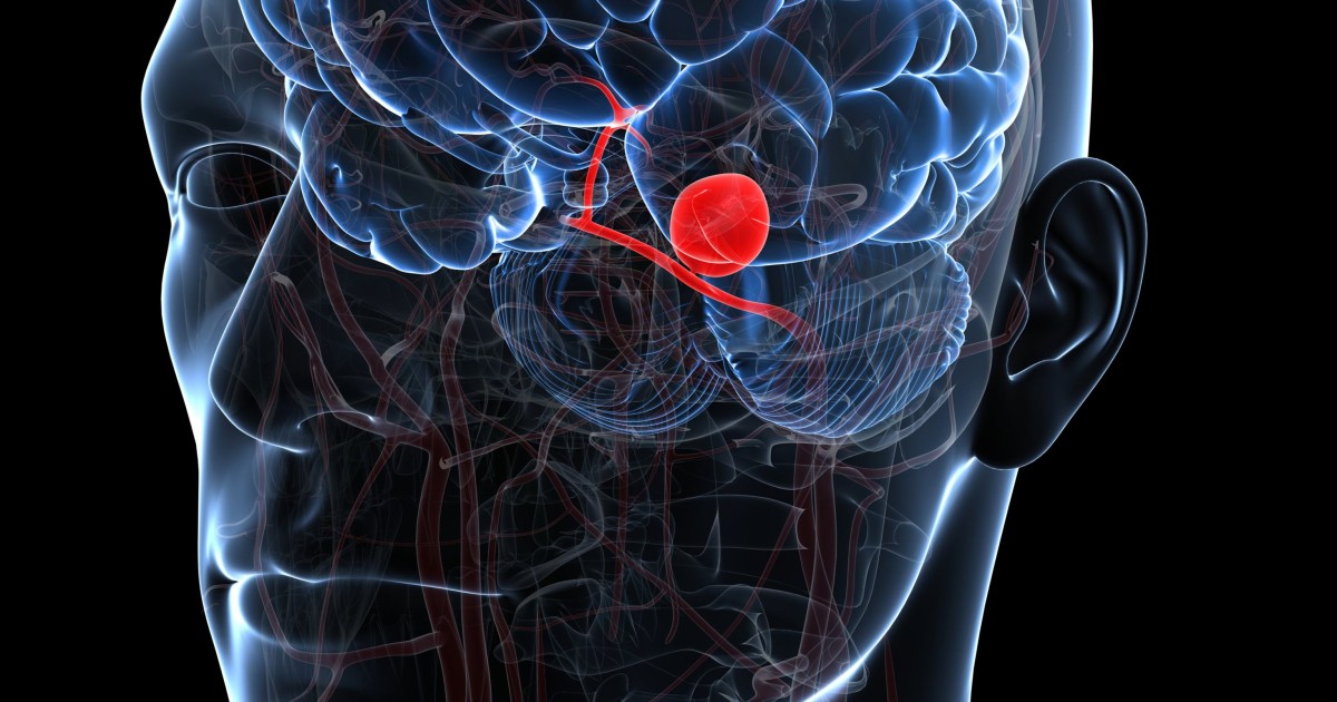 Headaches, stiff neck? Maybe you have a brain aneurysm. A neurologist explains what to look out for - Vimarsana News