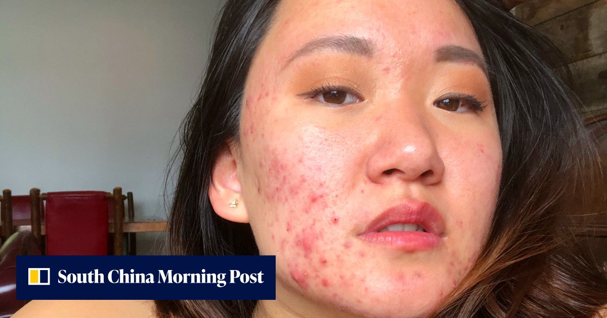 She's not ashamed of her acne any more: how the skin positivity movement helps those with severe breakouts learn to feel good in their own bodies - Vimarsana News