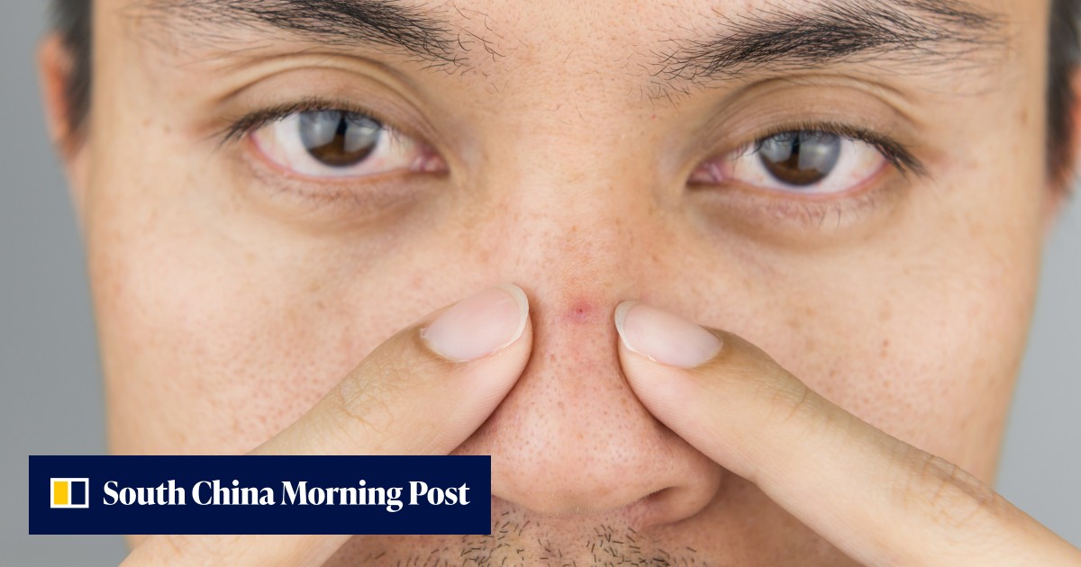 Why popping acne around the nose and top lip could lead to serious infection and even death: dermatologists give their top treatment tips - Vimarsana News