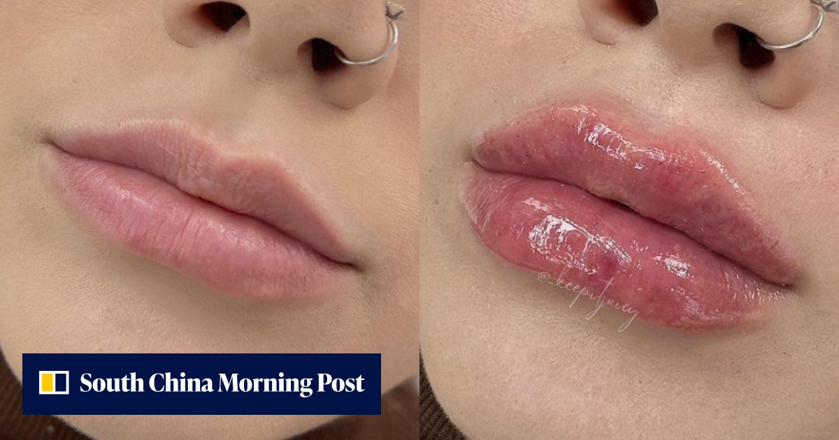 The hyaluron pen, a TikTok fave, gives you fuller lips at home – but experts warn it's not safe - Vimarsana News