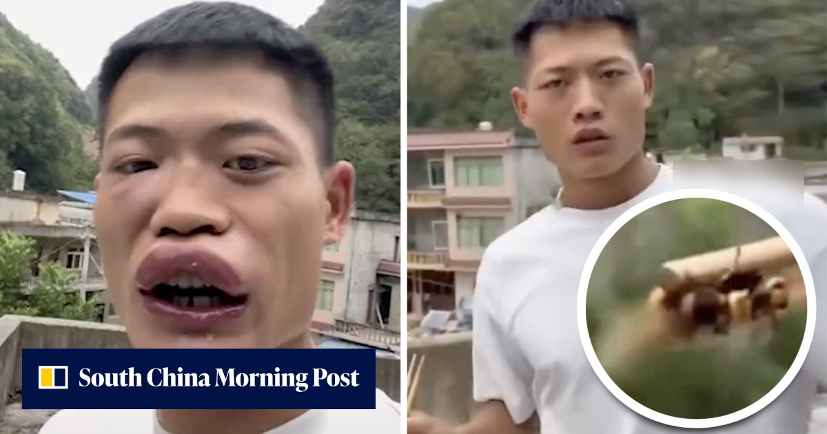 'Sausage lips': Chinese influencer cancelled after wasp-eating video stunt that causes public outcry and extremely swollen lips - Vimarsana News