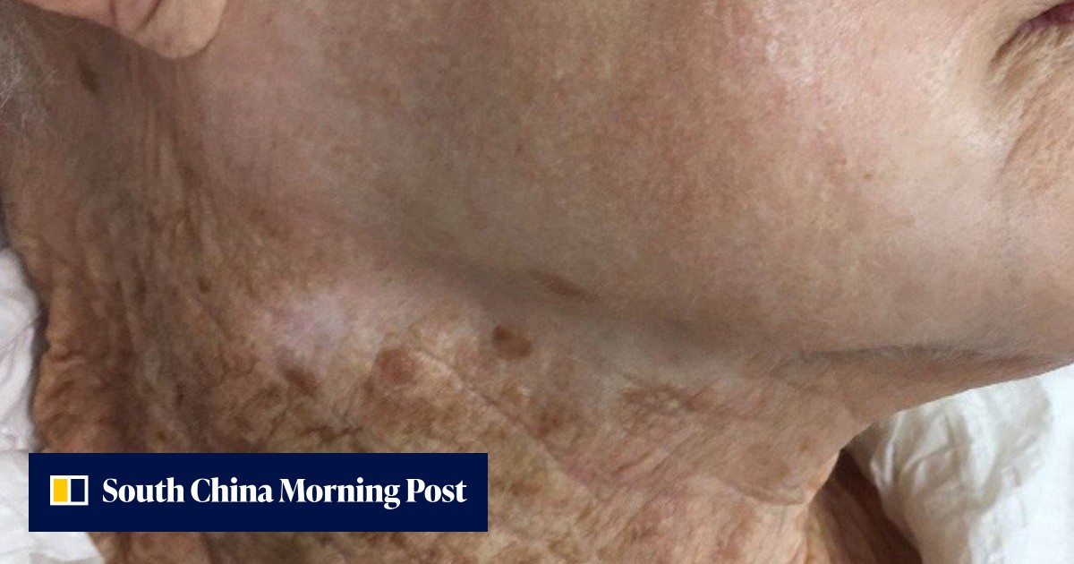 A photo showing 40 years of sun damage went viral, showing what happened to a 92-year-old woman who used sunscreen on her face but not her neck - Vimarsana News