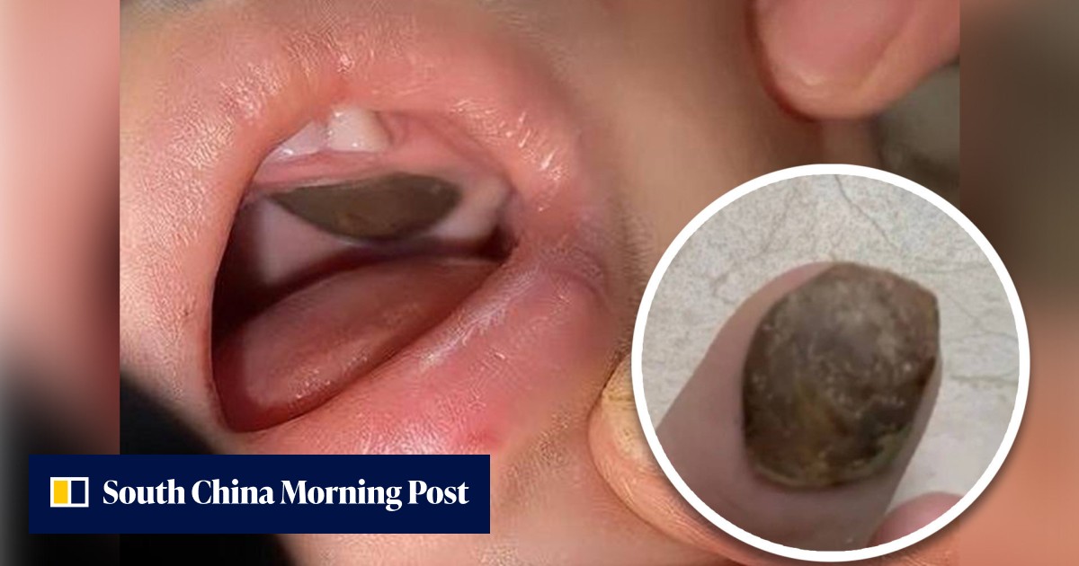 Chinese baby with lotus seed shell stuck in mouth misdiagnosed with tumour, embroiling public health system in scandal - Vimarsana News