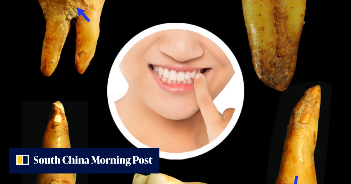 Do I have something in my teeth? Scientists find evidence of tooth picking in earliest humans in China - Vimarsana News