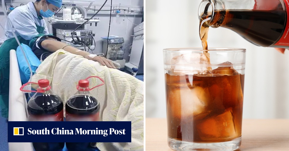 'Drink cola': doctor in China tells man to consume 2 big bottles of Coca-Cola for a week who is shocked after gastric stone disappears - Vimarsana News