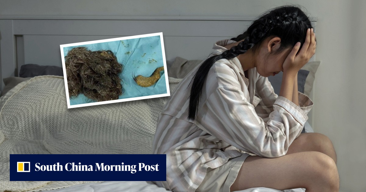 'Almost completely bald': teen girl in China pulls out and eats so much of her own hair there is no room for food in her stomach - Vimarsana News