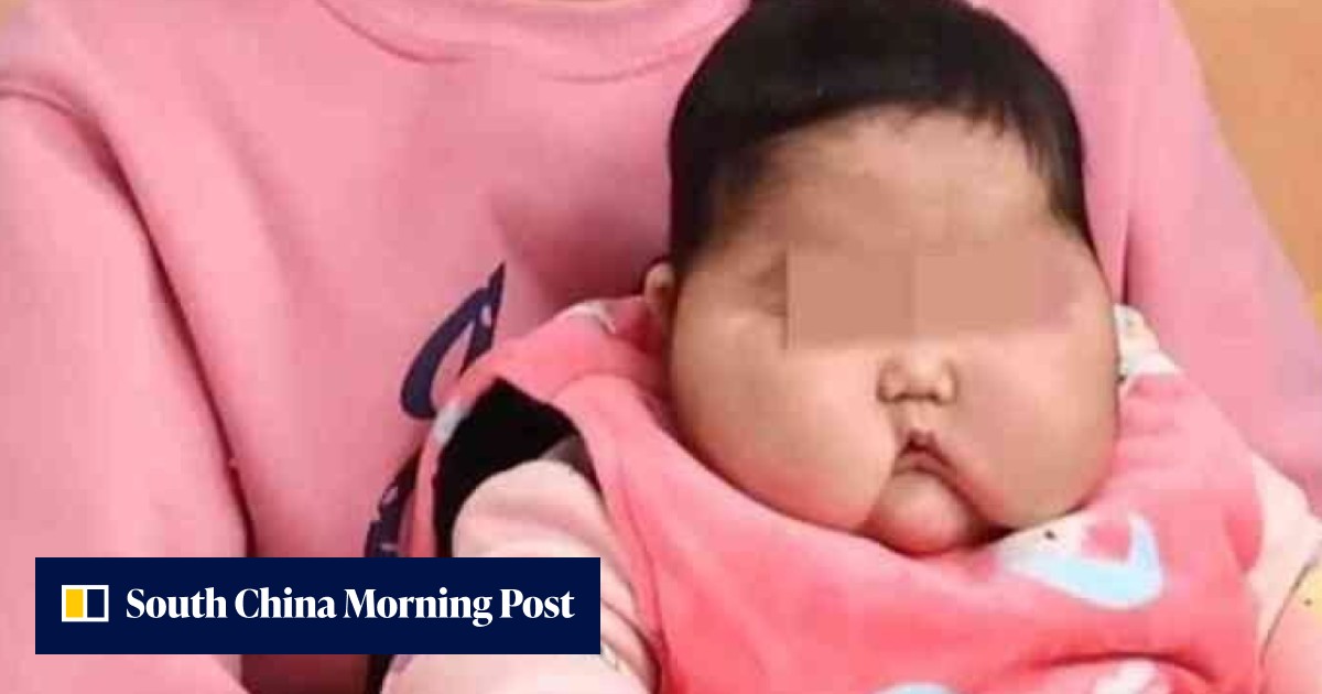 Steroid cream gives Chinese baby hairy cheeks and causes her weight to shoot up; angry dad demands answers from producer - Vimarsana News