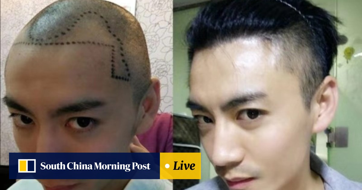 Millennial Chinese Men Going Bald Younger Getting Hair